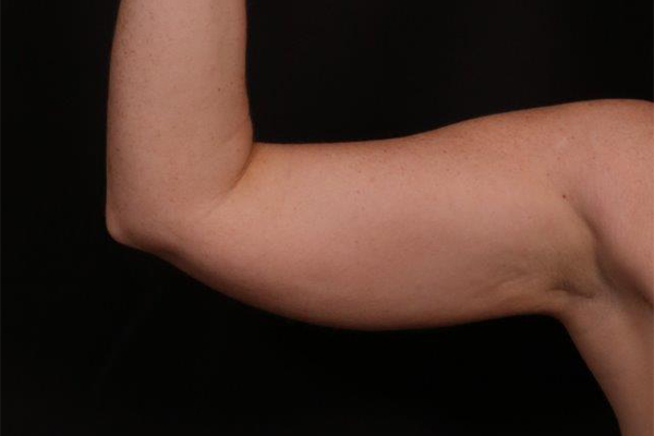 Before Image: Arm Liposuction - front