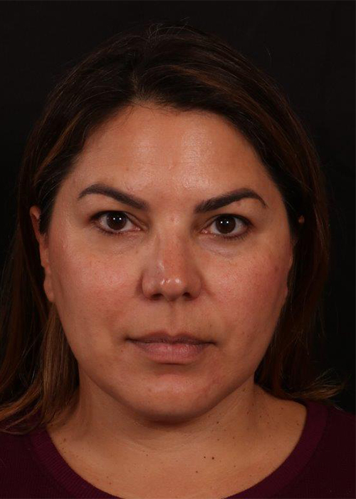 After Image: Buccal Fat Removal and Neck Lipo - front