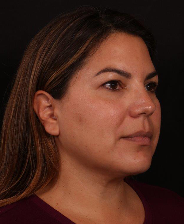 After Image: Buccal Fat Removal and Neck Lipo - right-front-oblique