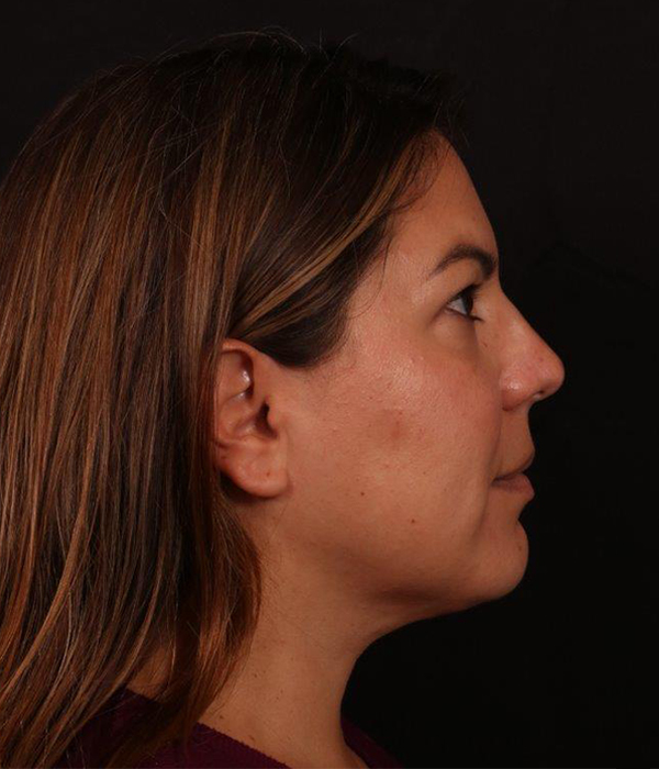 After Image: Buccal Fat Removal and Neck Lipo - right-side