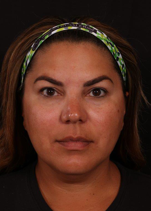 Before Image: Buccal Fat Removal and Neck Lipo - front