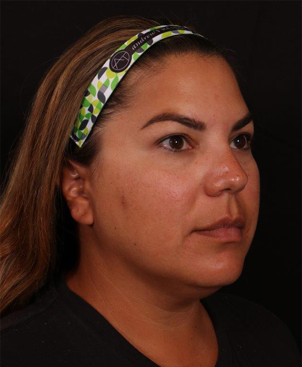 Before Image: Buccal Fat Removal and Neck Lipo - right-front-oblique