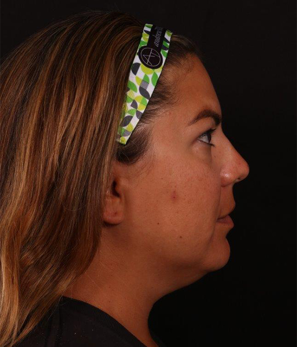 Before Image: Buccal Fat Removal and Neck Lipo - right-side