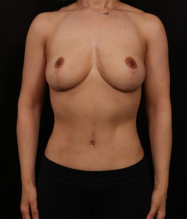 After Image: Mommy Makeover - front