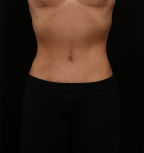 Tummy Tuck (Abdominoplasty) With Liposuction