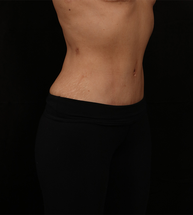 After Image: Tummy Tuck (Abdominoplasty) With Liposuction - right-front-oblique