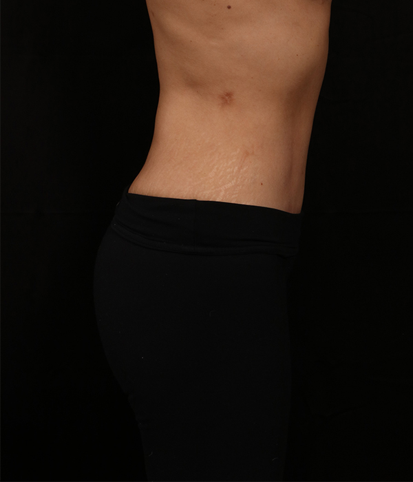 After Image: Tummy Tuck (Abdominoplasty) With Liposuction - right-side