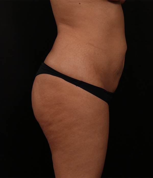 Before Image: Tummy Tuck (Abdominoplasty) With Liposuction - right-side