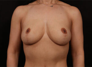 After Image: Breast Lift With Augmentation