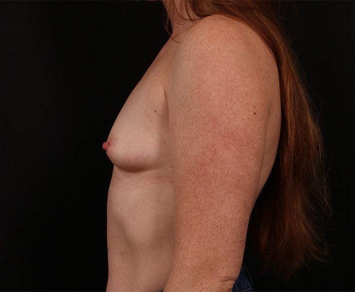 Before Image: Breast Augmentation - left-side