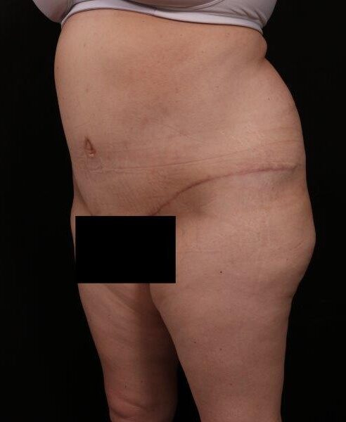 After Image: Tummy Tuck (Abdominoplasty) With Liposuction - left-front-oblique