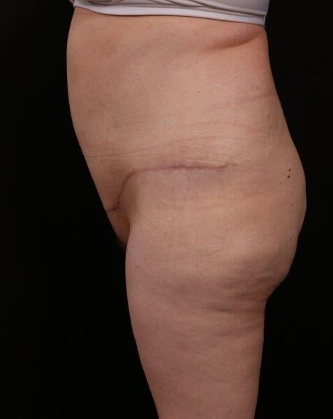 After Image: Tummy Tuck (Abdominoplasty) With Liposuction - front