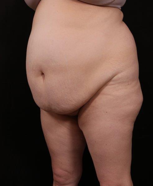 Before Image: Tummy Tuck (Abdominoplasty) With Liposuction - left-front-oblique