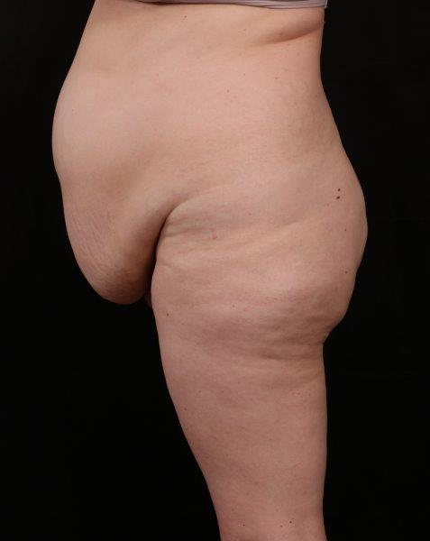 Before Image: Tummy Tuck (Abdominoplasty) With Liposuction - front