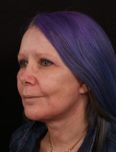 After Image: Face Lift with Chin Implant