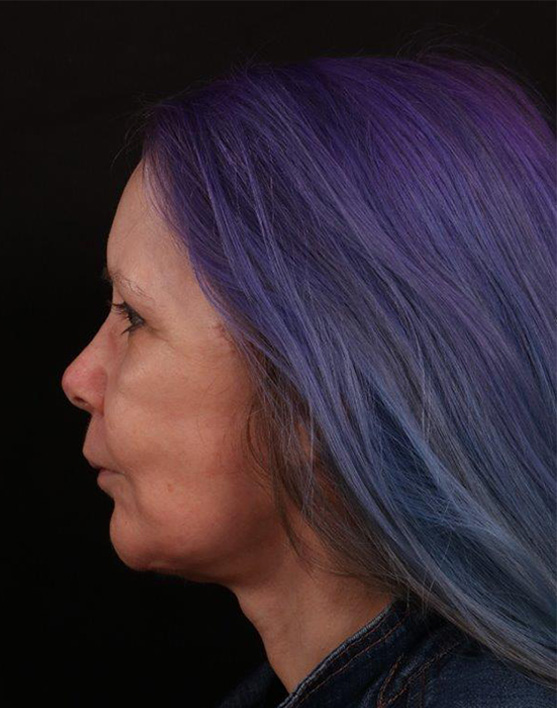 After Image: Face Lift with Chin Implant - left-side