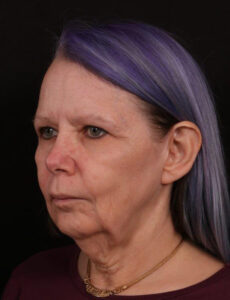 Before Image: Face Lift with Chin Implant