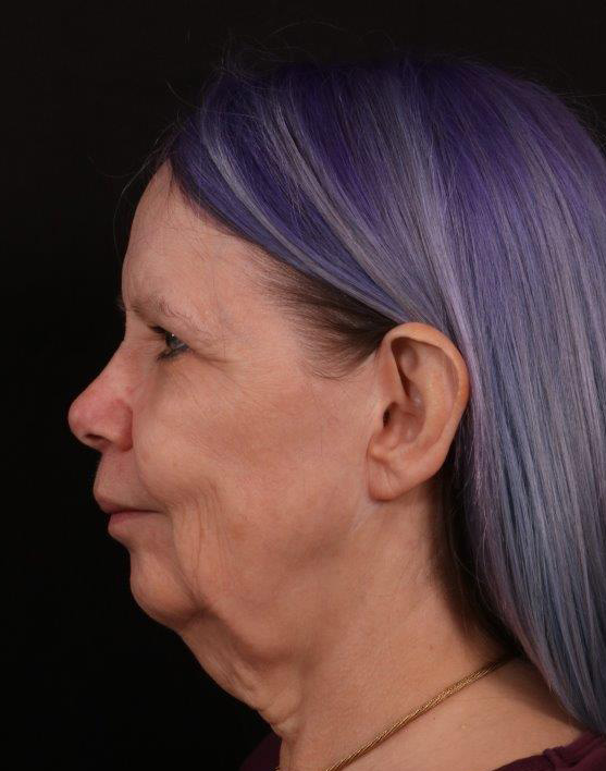 Before Image: Face Lift with Chin Implant - left-side