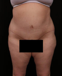 Tummy Tuck