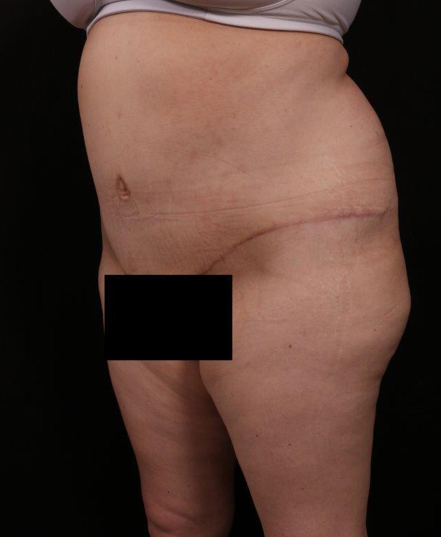 After Image: Liposuction - left-front-oblique