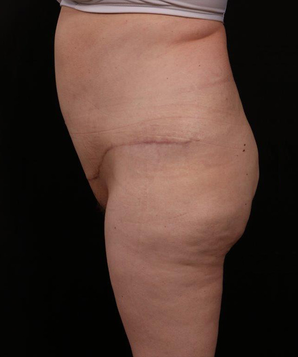 After Image: Liposuction - left-side