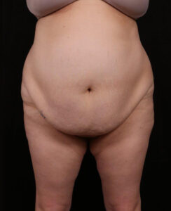 Tummy Tuck