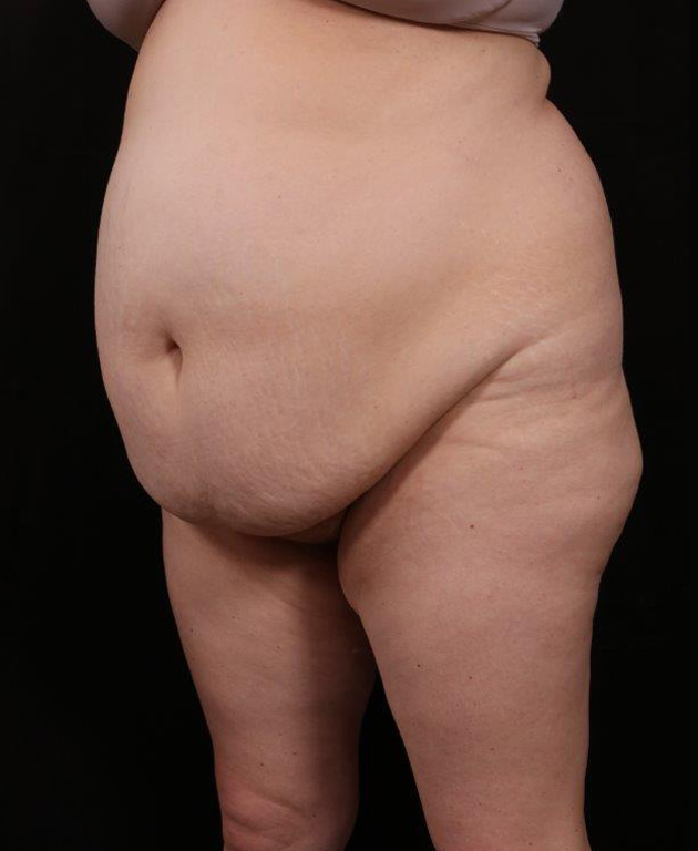 Before Image: Liposuction - left-front-oblique