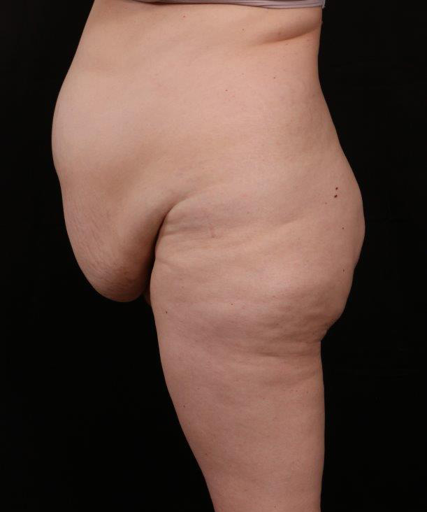 Before Image: Liposuction - left-side