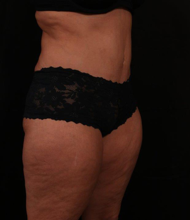 After Image: Tummy Tuck - right-front-oblique