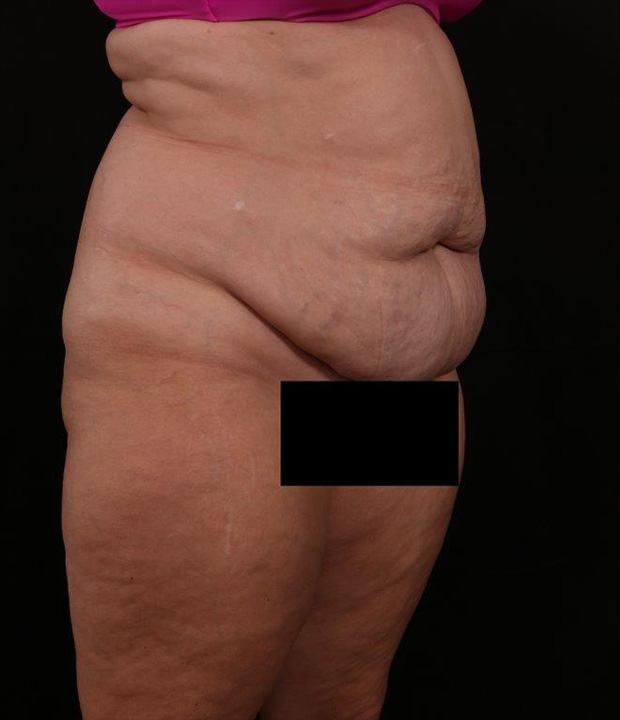 Before Image: Tummy Tuck - right-front-oblique
