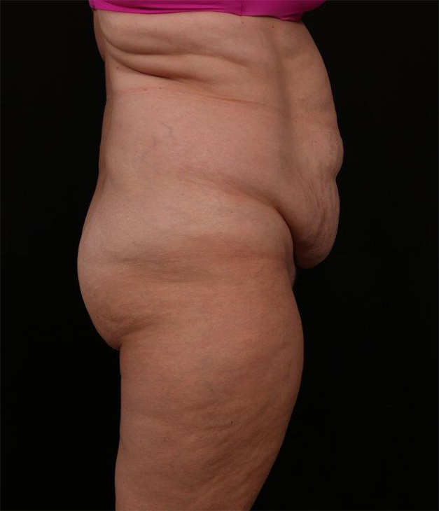 Before Image: Tummy Tuck - right-side