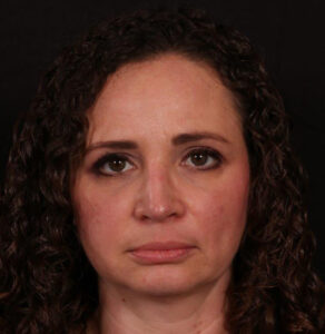 Rhinoplasty