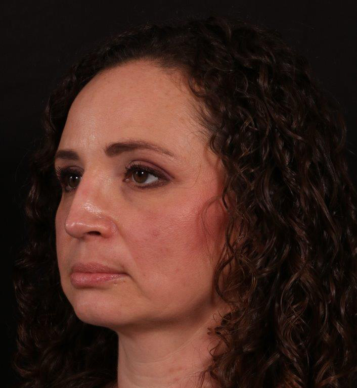 After Image: Rhinoplasty - left-front-oblique