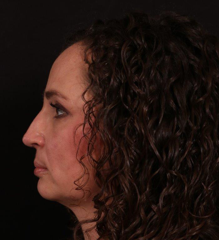 After Image: Rhinoplasty - 