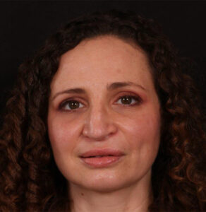 Rhinoplasty