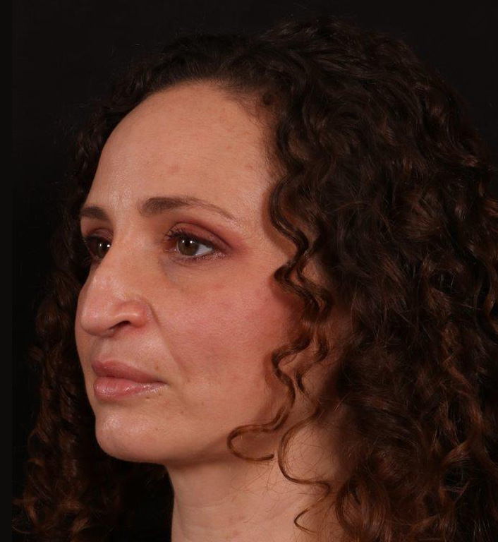 Before Image: Rhinoplasty - left-front-oblique