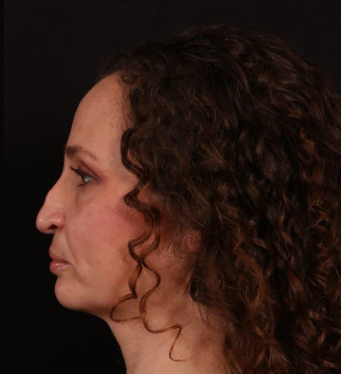 Before Image: Rhinoplasty - 