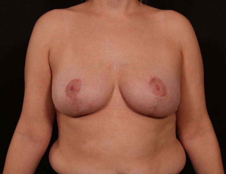 After Image: Mastopexy (Breast Lift) - front