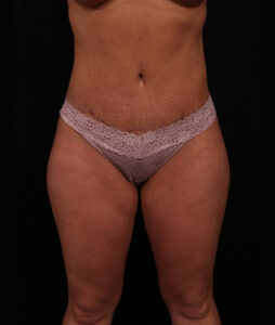 Tummy Tuck