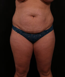 Tummy Tuck
