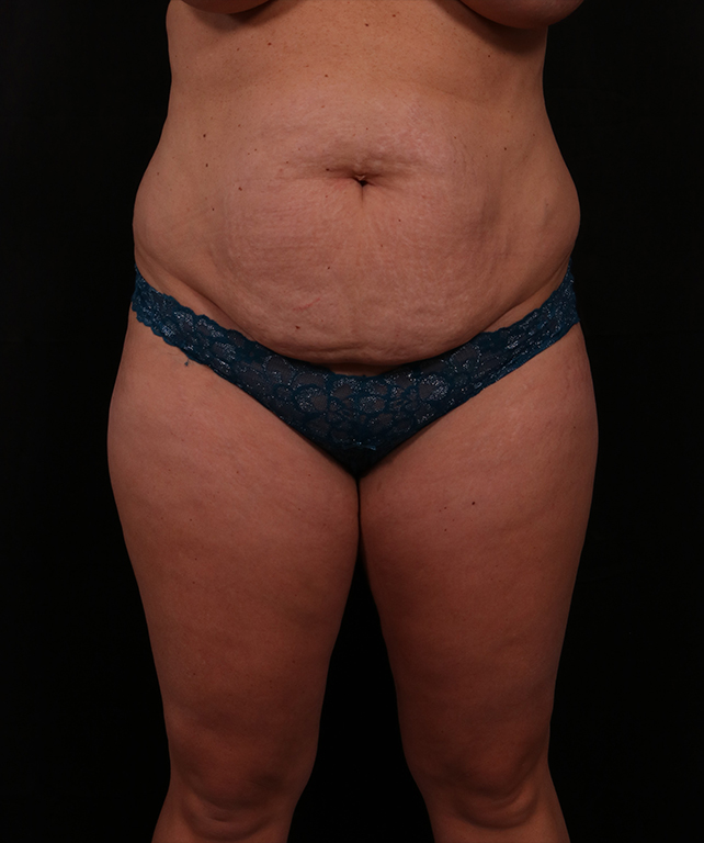 Before Image: Tummy Tuck - front