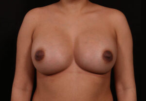 Breast Augmentation