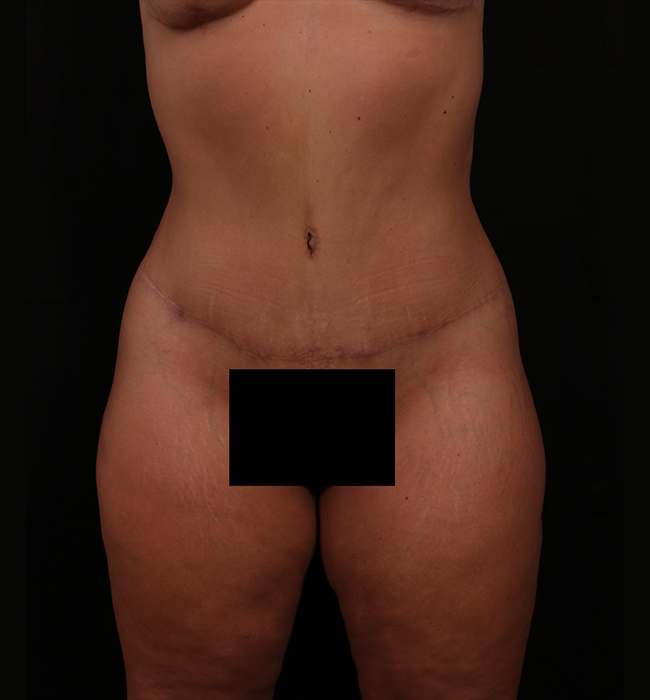 After Image: Tummy Tuck (Abdominoplasty) - front