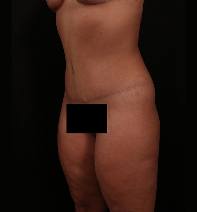 After Image: Tummy Tuck - left-front-oblique