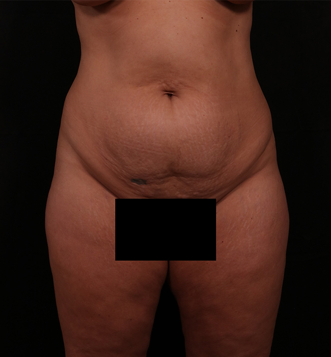 Before Image: Tummy Tuck (Abdominoplasty) - front