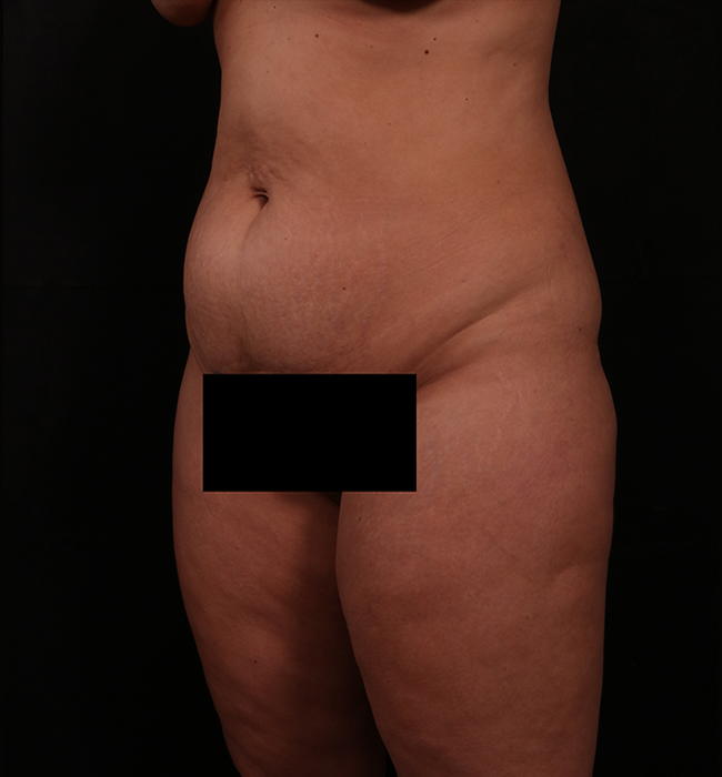 Before Image: Tummy Tuck - left-front-oblique