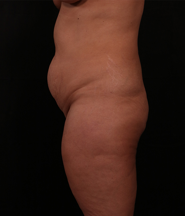 Before Image: Tummy Tuck - left-side