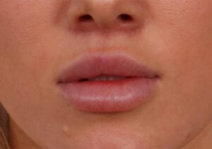 After Image: Lip Lift
