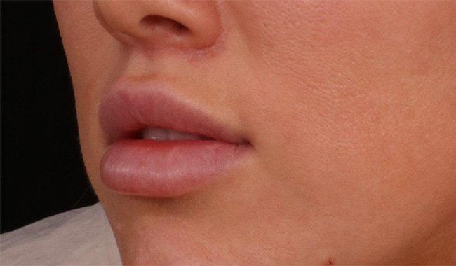 After Image: Lip Lift - left-front-oblique
