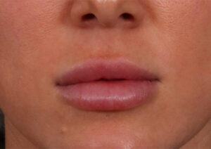 Before Image: Lip Lift